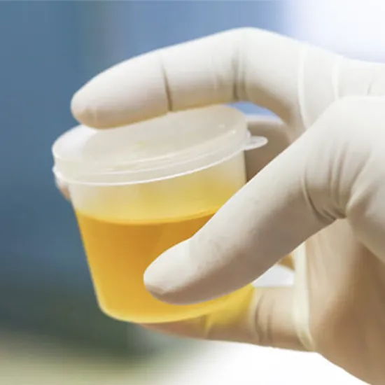 alkaptonuria urine test